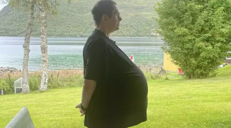 HOMEM DESCOBRE TOMOR NA BARRIGA DE 27kg APÓS TRATAR OBESIDADE POR 12 ANOS